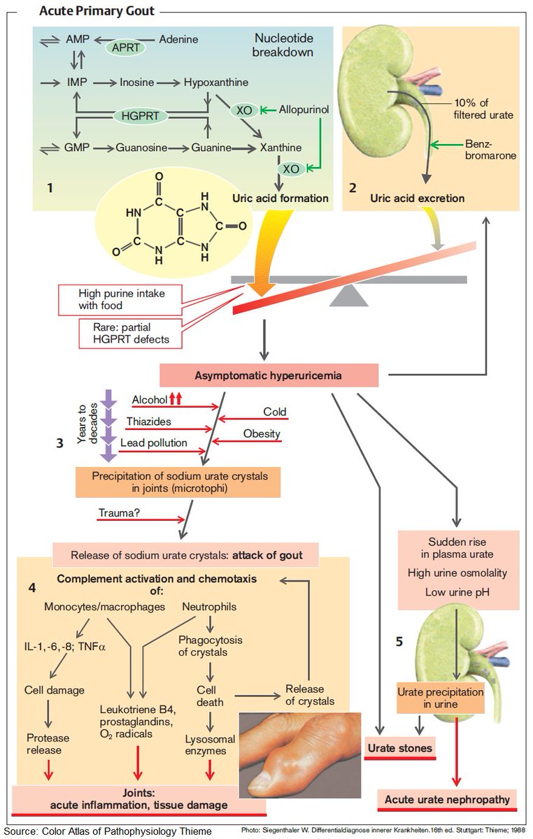 ManualOMedicine's tweet photo. Pathophysiology of Gout

#medtwitter #foamed #meded https://t.co/eahPMFLmPc