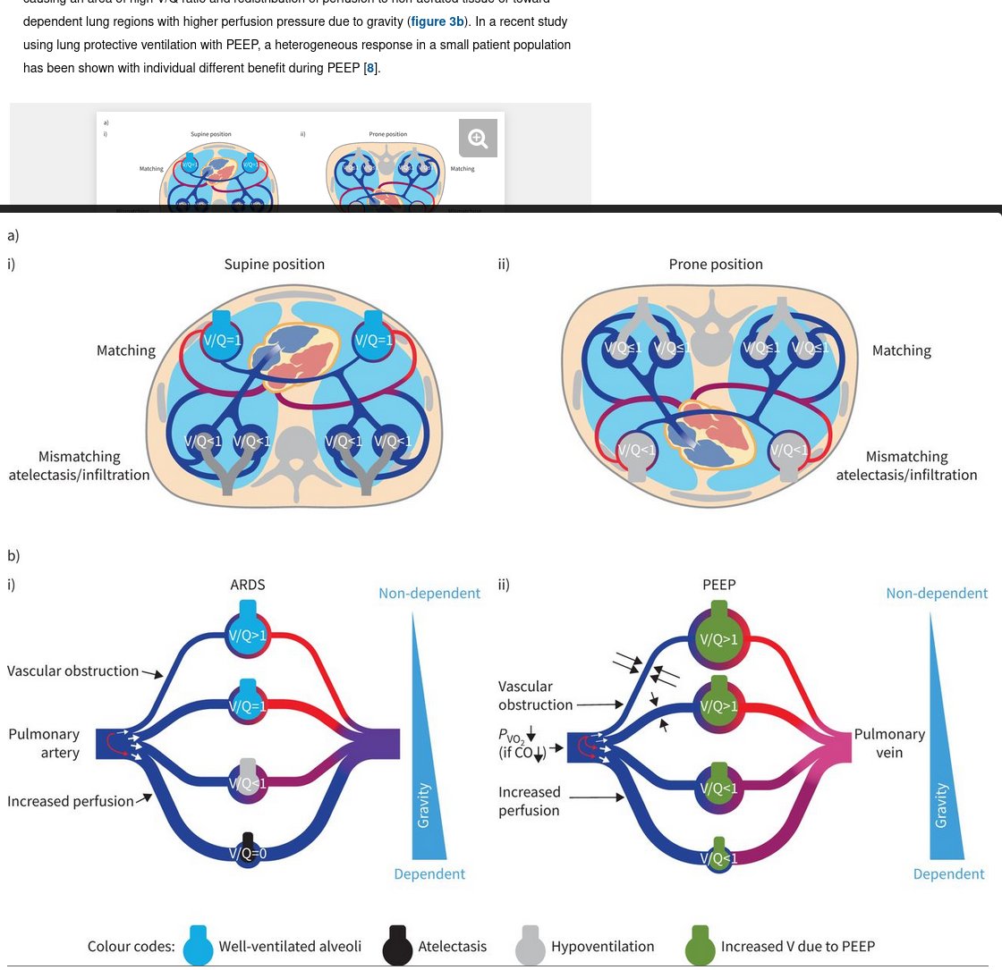 CritCareReviews's tweet photo. Today's paper of the day is by Mareike Gierhardt on the impairment of hypoxic pulmonary vasoconstriction in acute respiratory distress syndrome
https://t.co/JKgcYjlUQ5

Join us to read 1 paper per day and stay up-to-date as we cover the spectrum of critical care across 2023 https://t.co/45T7ocbTc9