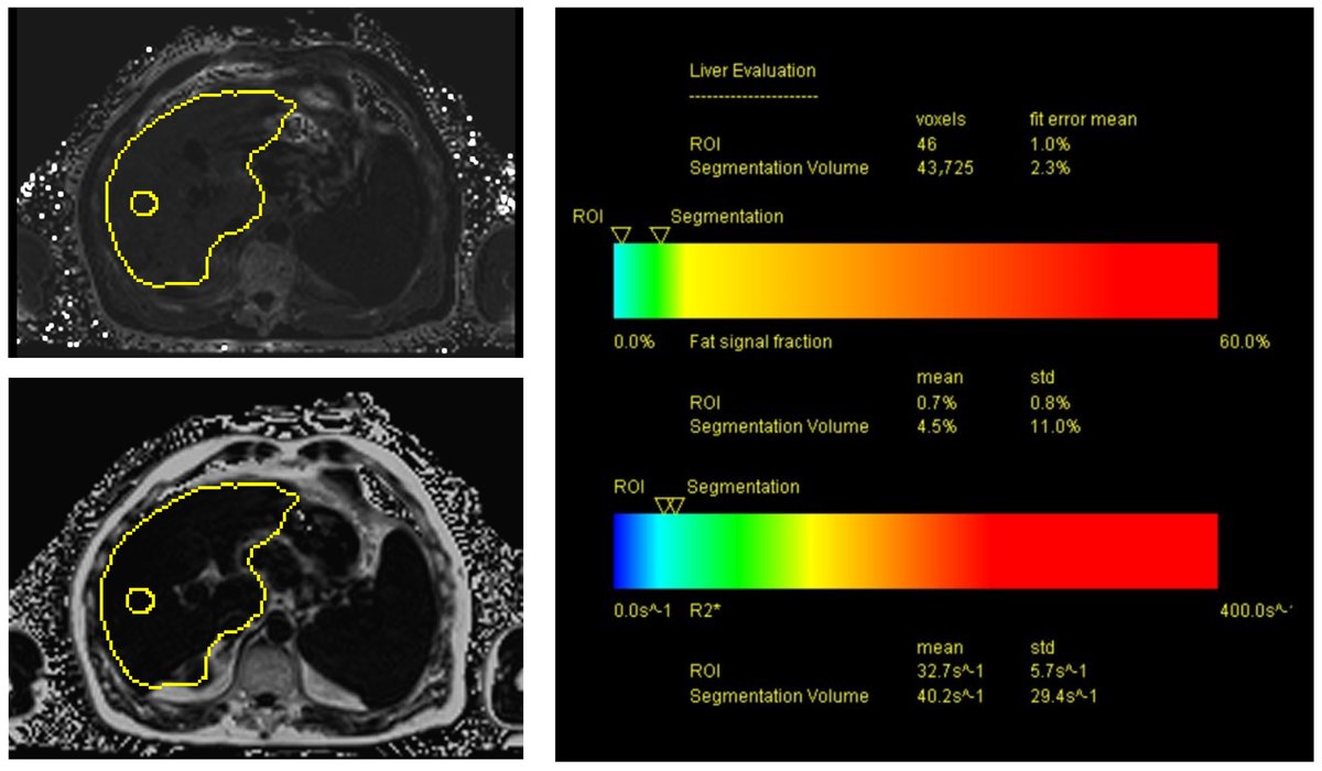 Tomography_MDPI's tweet image. 👋Different  #Ultrasound Shear Wave #Elastography Techniques as Novel Imaging-Based  Approaches for Quantitative Evaluation of Hepatic Steatosis—Preliminary  Findings by Dr. Natascha, et al.
#PDFF #tomography
@uni_regensburg @UniFreiburg @Uniklinikum_Wue
mdpi.com/2379-139X/9/2/…