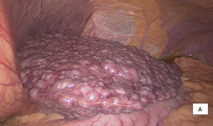 Sociedad Española de Patología Digestiva (SEPD) tweet media