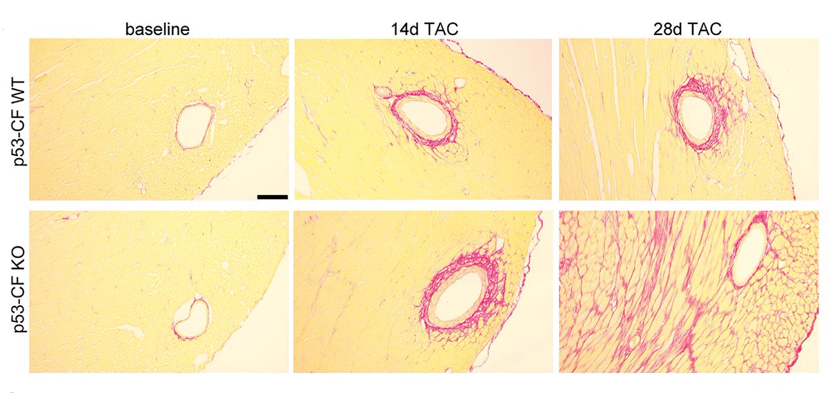 Circulation Research (@circres) on Twitter photo <a href="/XiaoyiLiu1227/">xiao yi</a>, et al found the tumor suppressor #p53 limits #fibroblast proliferation in heart disease to regulate the timing of #ECM deposition & the extent of cardiac #fibrosis. ahajrnls.org/43MQXX3
<a href="/Eric66867284/">Eric Small</a> @jentwa97@URMC_DeptMed <a href="/URochester_SMD/">URochester SMD</a> <a href="/XiaoyiLiu1227/">xiao yi</a>, et al found the tumor suppressor #p53 limits #fibroblast proliferation in heart disease to regulate the timing of #ECM deposition & the extent of cardiac #fibrosis. ahajrnls.org/43MQXX3
<a href="/Eric66867284/">Eric Small</a> @jentwa97@URMC_DeptMed <a href="/URochester_SMD/">URochester SMD</a>
