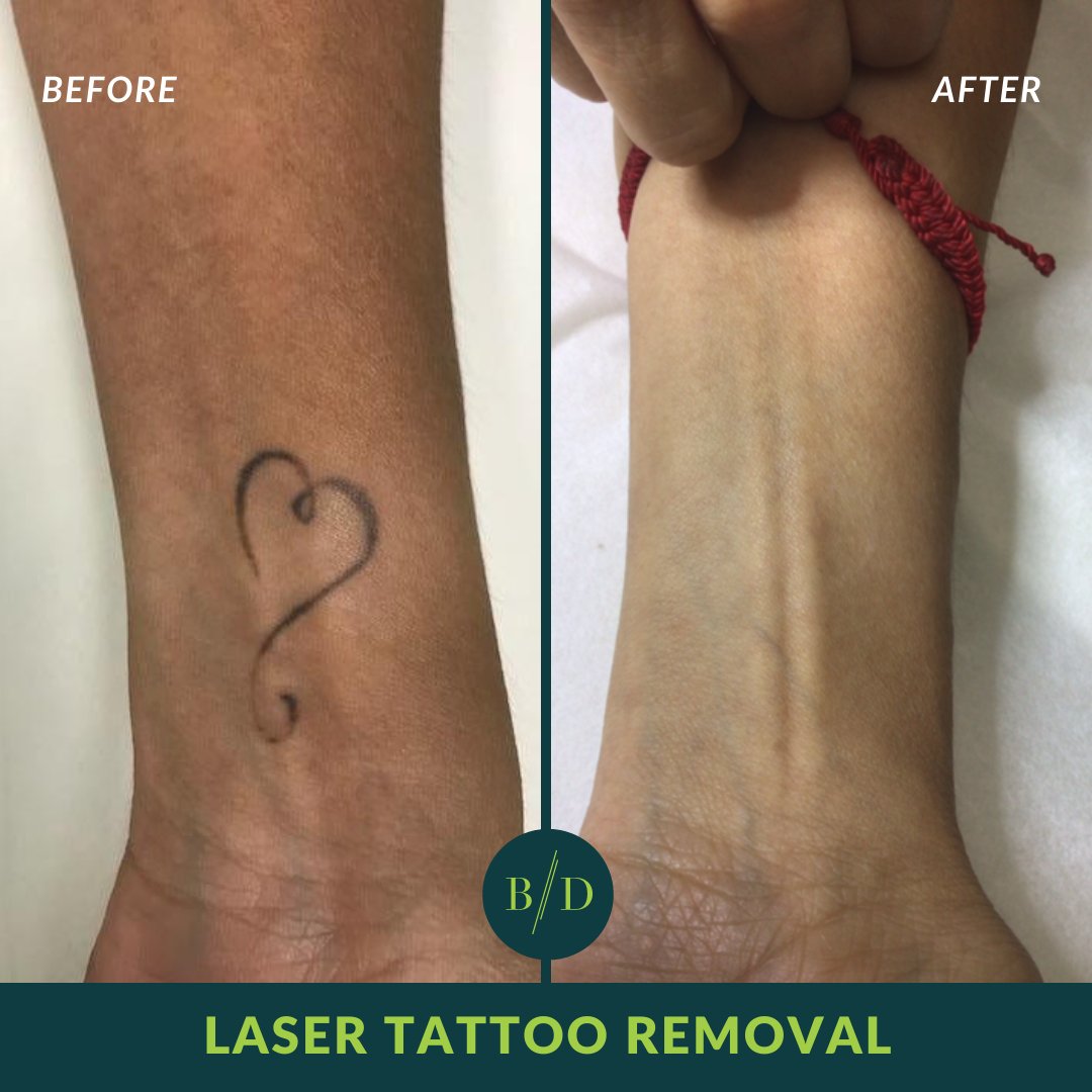 .
⭐️ Laser Tattoo Removal: Before & After  👉 
.
Or call us directly → 866-332-2639
.
#BodyDetails #southflorida #florida #lasertattooremoval #laserremoval #tattooregret #tattoo #lasertattooremovalspecialist #lasertattooremovalbeforeandafter
