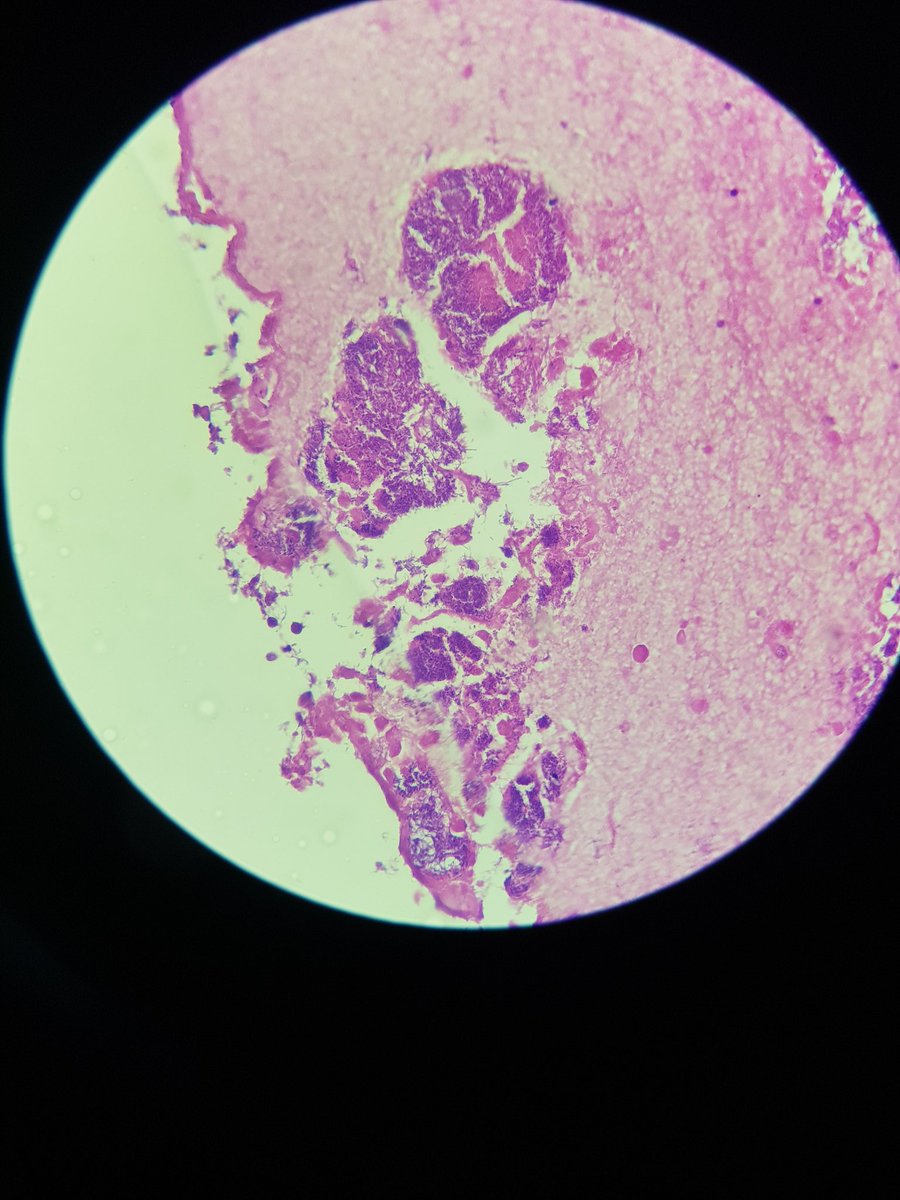AlaaRowaid_88's tweet photo. 🔬67 Yrs old male with history of bladder Cancer since 3 years ago 
Now pieces of tissue discharge .

🔬 Are these pic consistent with actinomycosis ?? https://t.co/gjpCAnM2b0
