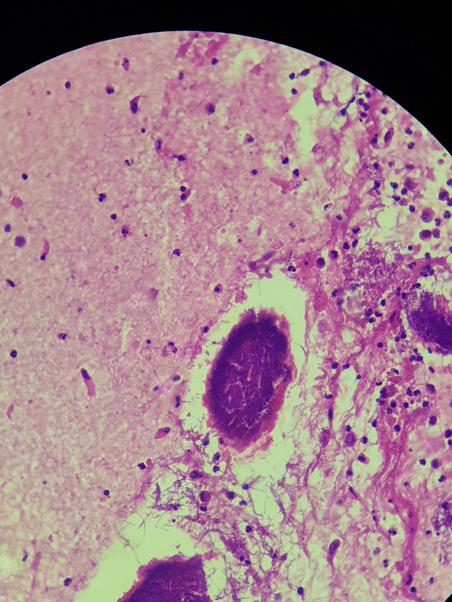 AlaaRowaid_88's tweet photo. 🔬67 Yrs old male with history of bladder Cancer since 3 years ago 
Now pieces of tissue discharge .

🔬 Are these pic consistent with actinomycosis ?? https://t.co/gjpCAnM2b0