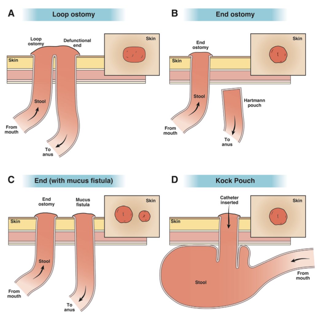 Carl Kay, MD (@carlkaymd) on Twitter photo Schematic of different types of ostomy configurations
▪️Loop ostomy
▪️End ostomy w/ Hartmann’s pouch
▪️End ostomy with mucus fistula
▪️Continent ileostomy (Kock pouch)
Great update on management strategies!
🔗 sciencedirect.com/science/articl…
🙏 <a href="/ShirleyCoMekMD/">Shirley Cohen</a> <a href="/AGA_Gastro/">Gastroenterology</a>
#GITwitter Schematic of different types of ostomy configurations
▪️Loop ostomy
▪️End ostomy w/ Hartmann’s pouch
▪️End ostomy with mucus fistula
▪️Continent ileostomy (Kock pouch)
Great update on management strategies!
🔗 sciencedirect.com/science/articl…
🙏 <a href="/ShirleyCoMekMD/">Shirley Cohen</a> <a href="/AGA_Gastro/">Gastroenterology</a>
#GITwitter