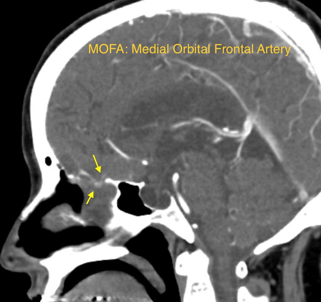 54 y/o lady with CSF rhinorrhea.

She has large meninoencephalocele. 

CTA/MRA is required in such cases to rule out looping of MOFA within the herniated part. 

It helps in the surgical planning, preparation and avoid complications. 

#rhinology 
#skullbase
#tweetorial