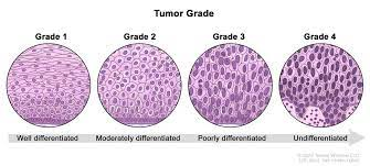 immunooncol's tweet photo. #Tumor grade – defined as the degree of resemblance of the tumor #cells to the surrounding tissue. A low grade tumor resembles the surrounding normal tissues closely while a high grade tumor is very different from surrounding #tissues. https://t.co/P74jRkL3V8