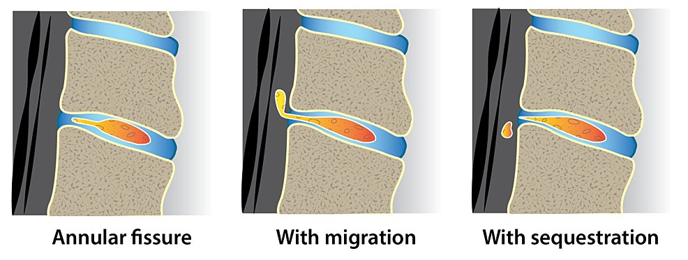 New 📰 to read!
The Invasive Management of #Pain: Diagnosis and New Treatment Options by Mayoral Rojals V et al.
Read more ➡️bit.ly/3KnUG6q
<a href="/giuvarr/">giuvarr</a> <a href="/vmayoral/">Victor Mayoral Rojals</a>