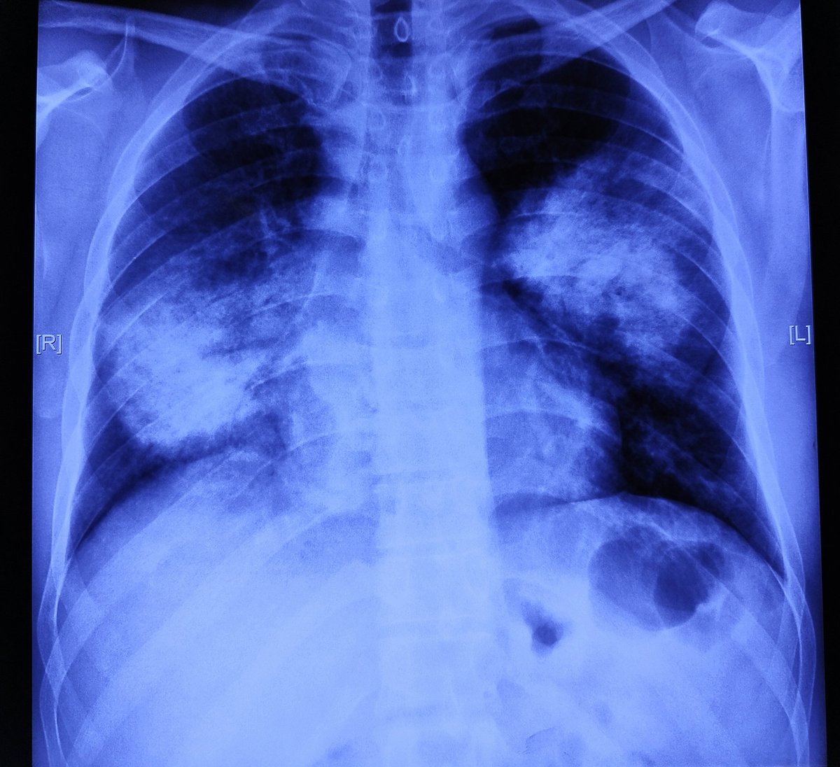 nihar_nayak2's tweet photo. Young male
Fever, cough for 10 days.
SOB for 3 days.
No co-morbidity
AKI (+)
Mild transaminitis. https://t.co/9iOim0z7yx