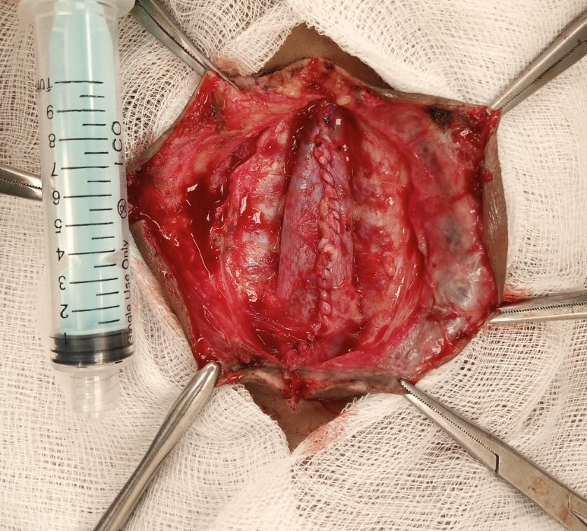 TamayoHorta's tweet photo. Px F, 3 months, flexion to plantar stimuli, not Babinski. With extensive lumbar #myelomeningocele. Repair is done today in #Maradi, #Niger. Flap rotation not required. Partial resection of epithelialized #placode 

#Neurosurgery #dysraphism https://t.co/D85u0Nylgn