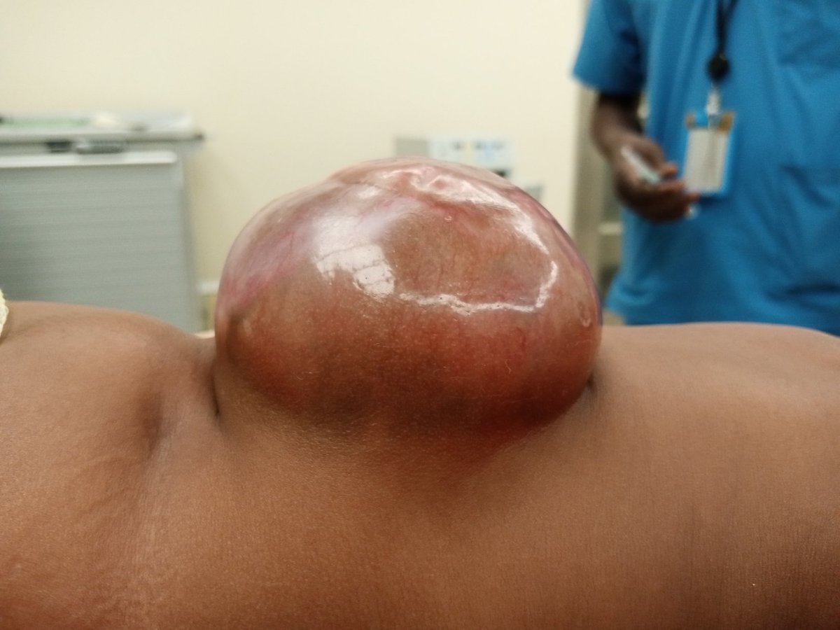 TamayoHorta's tweet photo. Px F, 3 months, flexion to plantar stimuli, not Babinski. With extensive lumbar #myelomeningocele. Repair is done today in #Maradi, #Niger. Flap rotation not required. Partial resection of epithelialized #placode 

#Neurosurgery #dysraphism https://t.co/D85u0Nylgn