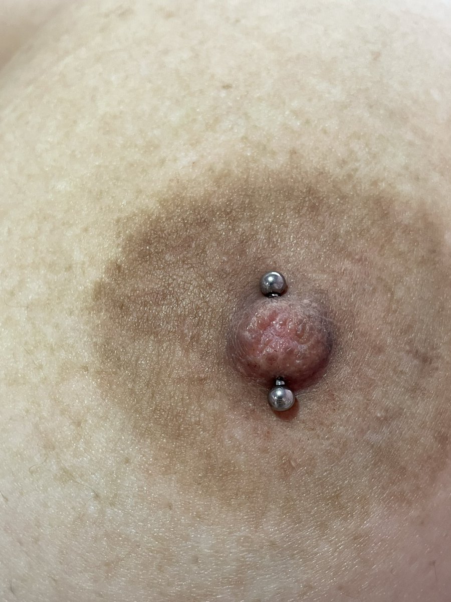 nirvanaPiercer's tweet photo. Perfuração Mamilo, feita aqui no Studio. Vamos agendar ?

Jóias em Titânio grau implante ASTM-F136 100% com pedras de opala azul ( hipoalergênico )

•simetria•
•procedimento asséptico•
•biossegurança•
•ângulo•
•material estéril•

✨Venha se adornar✨ https://t.co/yDEIzMXlUp