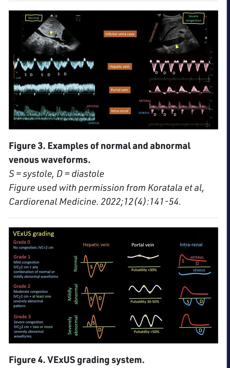 KalagaraHari's tweet photo. #POCUS 
Thrilled to see #VExUS made its way to our @ASRA_Society POCUS Spotlight series. 
Many thanks 🙏 to expert authors @curromir @ArgaizR @NephroP 🙏
👉 https://t.co/i4EbzGYvkS @MKwesiKwofie @nathanhwaldron @pmgjones @shaskinsMD @NibrasBughrara @iceman_ex @Wilkinsonjonny https://t.co/j7T2lIGu1T