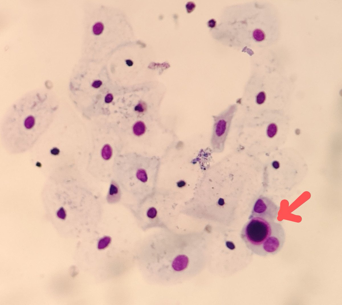 AnupamaArya12's tweet photo. 45/F urine .Pt presented with one episode of hematuria #cytopath #pathtwitter #urine need help in identifying this intracytoplasmic structure.@pepeheffernan @vi_monappa @kriyer68 @kr_abhisek @DrGeeONE @DrLakshmirao2 https://t.co/gweDw5x7Wx