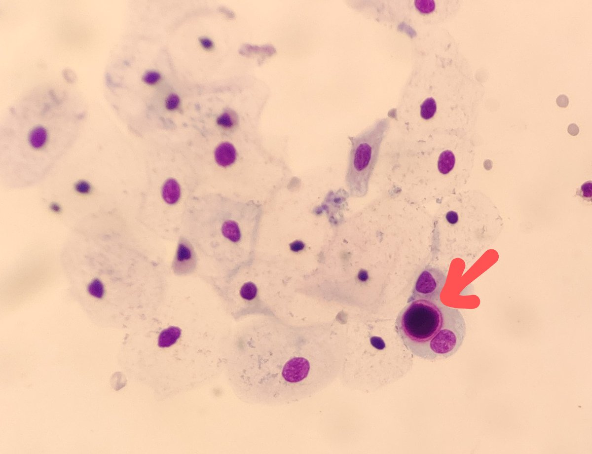 AnupamaArya12's tweet photo. 45/F urine .Pt presented with one episode of hematuria #cytopath #pathtwitter #urine need help in identifying this intracytoplasmic structure.@pepeheffernan @vi_monappa @kriyer68 @kr_abhisek @DrGeeONE @DrLakshmirao2 https://t.co/gweDw5x7Wx