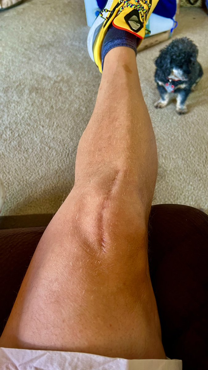 FHSBioVinson's tweet photo. I year ago today I had a PKR. Dr. said I am doing well and to not come back for 10 years unless there are issues. #runner4life @drinkhoist @TeamRWBDayton @TeamRWBCincy @TeamRWB https://t.co/oakB3bWx7c