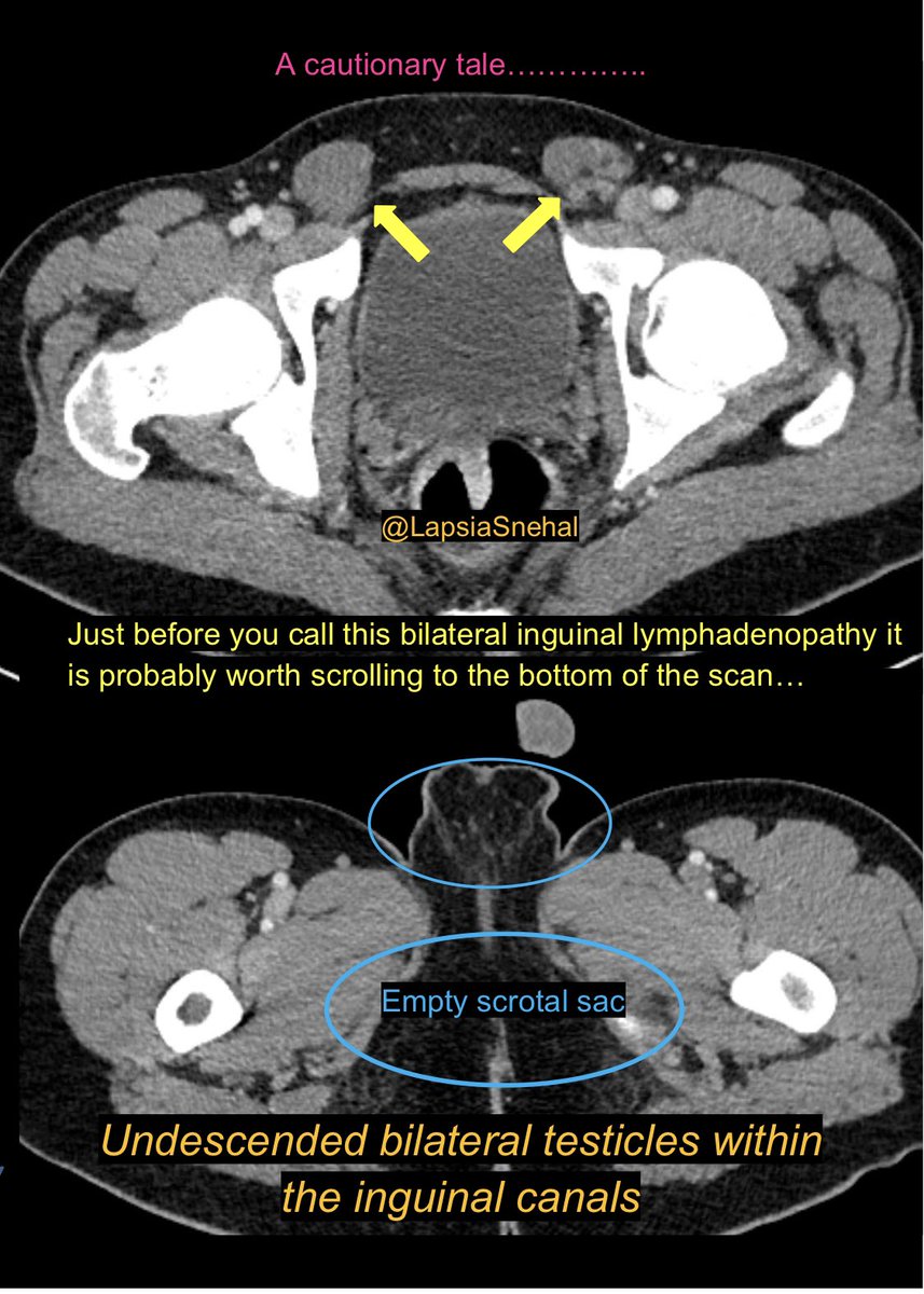 A cautionary tale ….  #FOAMrad #FOAMed #meded  #radres #futureradres #medstudenttwitter #gitwitter #anatomy #frcr #surgery #radiology #radtwitter #medtwitter #meded #urology #irad