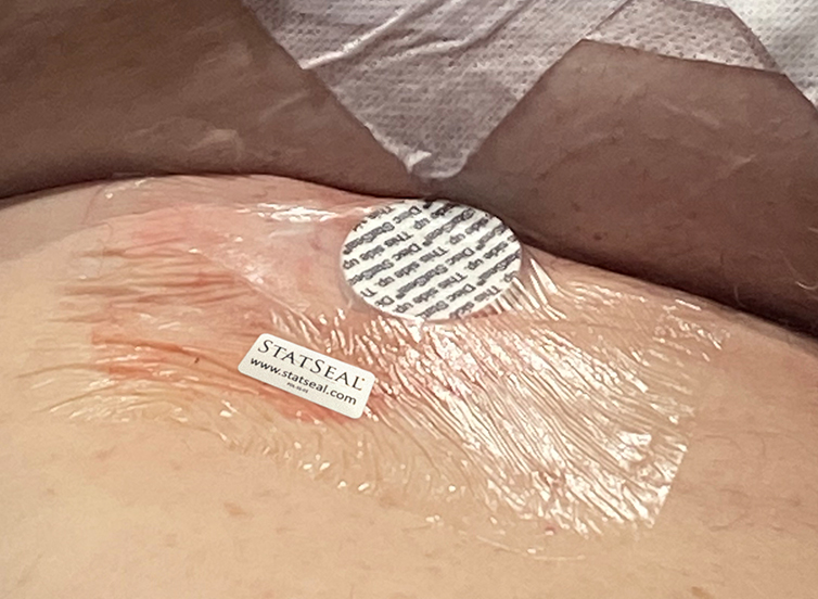 StatSeal's tweet photo. Essex Cardiothoracic Centre earns award for study that demonstrates StatSeal efficacy for groin closure following atrial fibrillation ablation procedures to treat patients with irregular heartbeats. https://t.co/Wy0cGdD8Qm
#statseal #atrialfibrilliation #TheRealRLPeralta https://t.co/6fMcIDDlJw