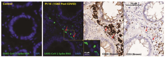 MichaelPelusoMD's tweet photo. Our new #UCSF preprint showing prolonged tissue-level immune activation and gut viral persistence for up to 2 years post-COVID.   Does COVID-19 induce a new immunologic set-point and how is this related to PASC/Long COVID?

https://t.co/nZRVkAy8MZ https://t.co/sCpfxDRJyV