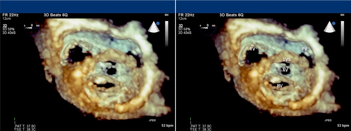 American Society of Echocardiography (@ase360) on Twitter photo A "Monkey in the Heart," submitted by <a href="/fmahmood543/">Feroze Mahmood</a>! 🐵
"This is a full volume view of the base of the heart from the left ventricular apex. This image shows the RV inflow (TV) and outflow (PV) and LV inflow (MV) and outflow (AV) with the Interventricular septum." - <a href="/fmahmood543/">Feroze Mahmood</a> A "Monkey in the Heart," submitted by <a href="/fmahmood543/">Feroze Mahmood</a>! 🐵
"This is a full volume view of the base of the heart from the left ventricular apex. This image shows the RV inflow (TV) and outflow (PV) and LV inflow (MV) and outflow (AV) with the Interventricular septum." - <a href="/fmahmood543/">Feroze Mahmood</a>