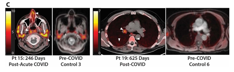 MichaelPelusoMD's tweet photo. Our new #UCSF preprint showing prolonged tissue-level immune activation and gut viral persistence for up to 2 years post-COVID.   Does COVID-19 induce a new immunologic set-point and how is this related to PASC/Long COVID?

https://t.co/nZRVkAy8MZ https://t.co/sCpfxDRJyV