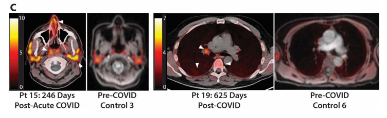 Our new #UCSF preprint showing prolonged tissue-level immune activation and gut viral persistence for up to 2 years post-COVID. Does COVID-19 induce a new immunologic set-point and how is this related to PASC/Long COVID? medrxiv.org/content/10.110…