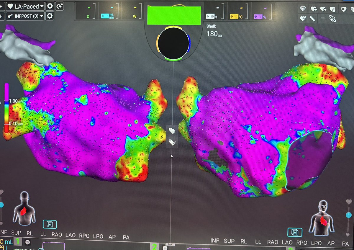 HRMCBrussel's tweet photo. Great first case with @AfferaEP at @UZBrussel Congratulations to @AndreaSarkozy @deasnostos @dogi84md @LuigipannoneM and all the @HRMCBrussel team @cespon_maria @IDoundoulakis @GiampaoloVetta @AlviseDelMonte @LMarcon111 @Medtronic @medtroniceu #epeeps @EHRAPresident @ESC_Journals https://t.co/lOKL6HhWoY