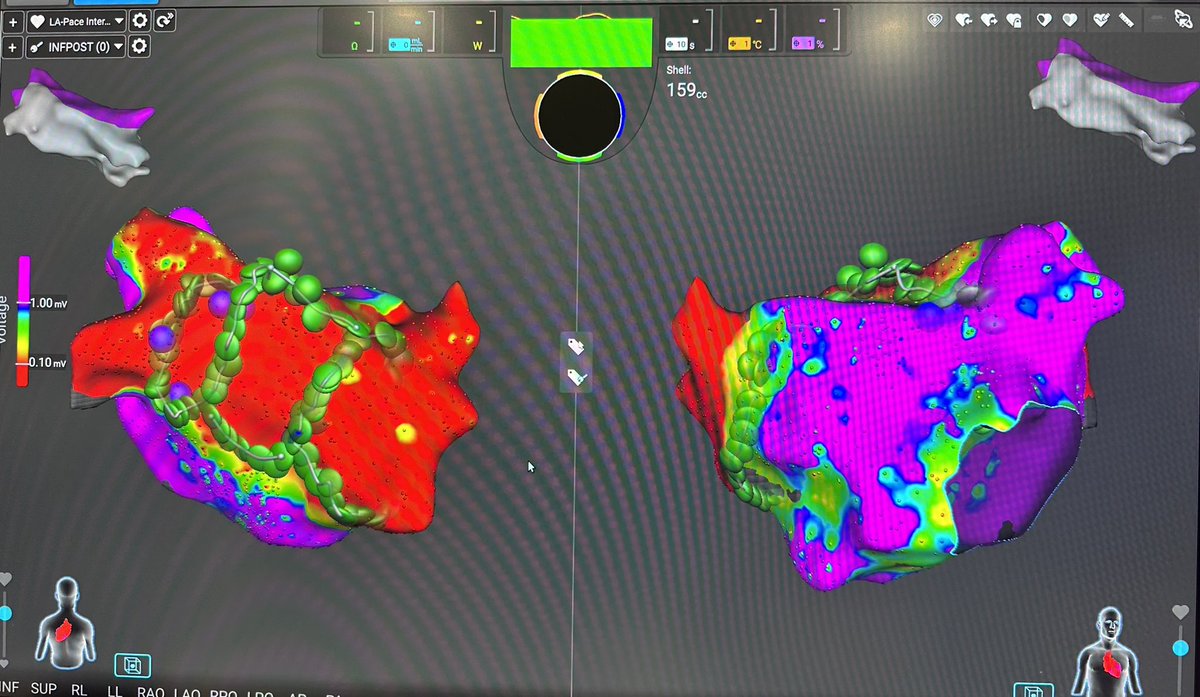 HRMCBrussel's tweet photo. Great first case with @AfferaEP at @UZBrussel Congratulations to @AndreaSarkozy @deasnostos @dogi84md @LuigipannoneM and all the @HRMCBrussel team @cespon_maria @IDoundoulakis @GiampaoloVetta @AlviseDelMonte @LMarcon111 @Medtronic @medtroniceu #epeeps @EHRAPresident @ESC_Journals https://t.co/lOKL6HhWoY