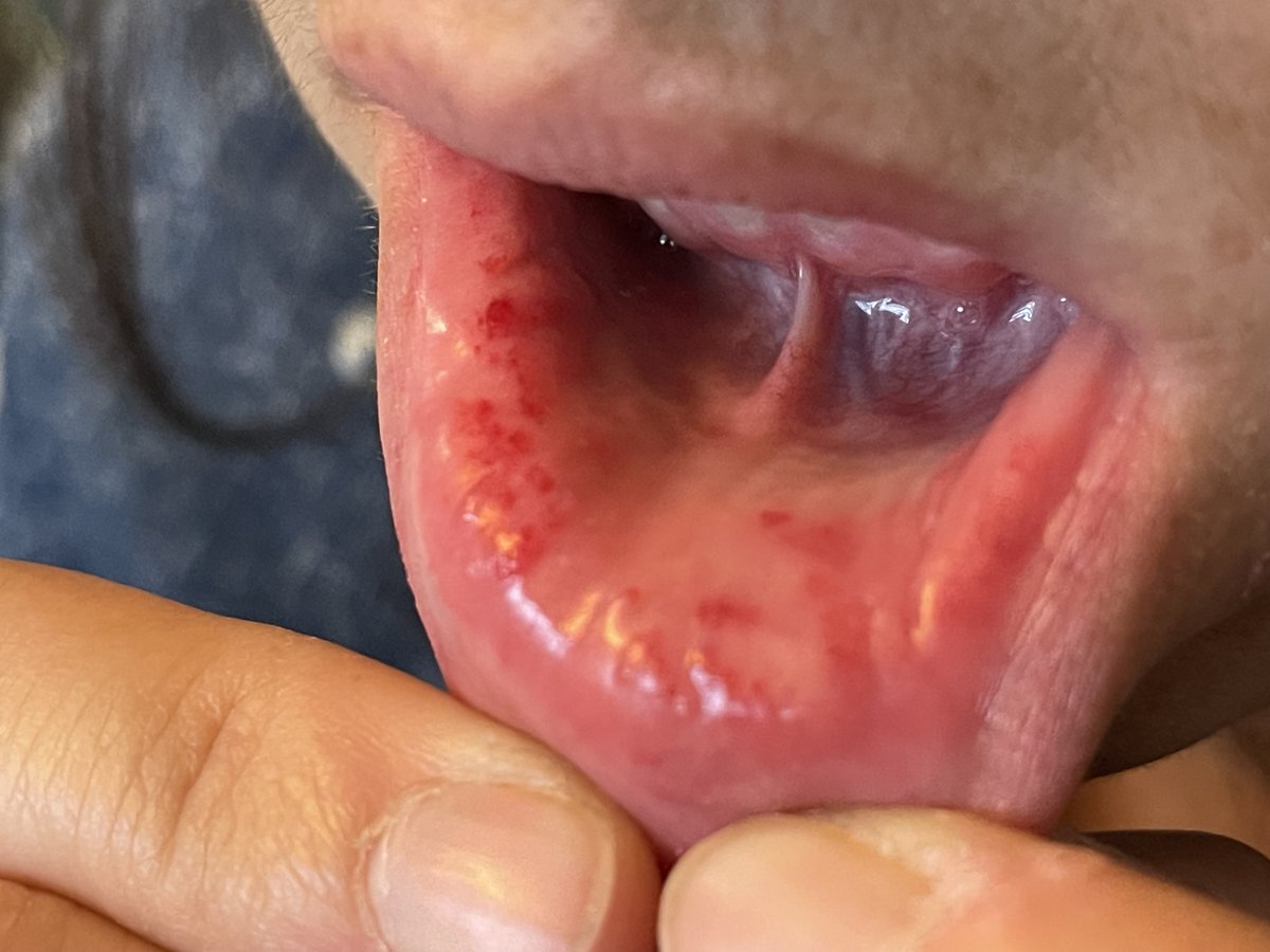 #DocTocToc F33a avec lésions papulaires et purpuriques de face interne des lèvres. candidose buccale associée. Pas de ctxt pathologique, pas de ttmt. Asthénie depuis 15 jours majorée. clinique RAS par ailleurs. Vous avez des idées ? Merci 🙂