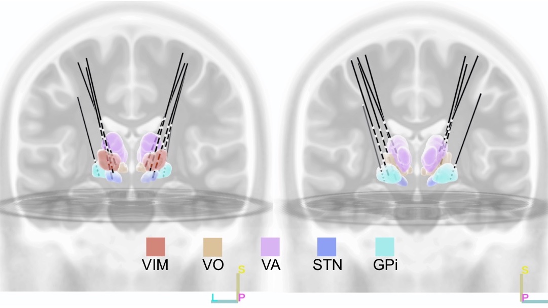 jrealmuto_'s tweet photo. Deep brain stimulation is a highly effective therapy for an increasing number of neurological and psychiatric disorders. However, the optimal electrode placement and stim parameters are individualized and thus careful planning and tuning are required. https://t.co/DjbTO1tRAV