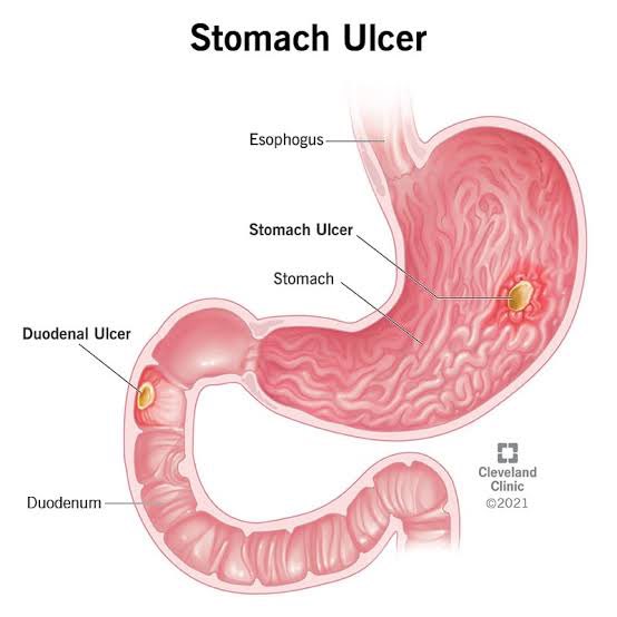 g_diets_'s tweet photo. Ulcer is not caused by hunger or fasting 

Ulcer is caused by H Pylori, Hypo-acidity of the gut, certain NSAIDs medications triggering inflammation.

Ulcer can be treated by removing the triggers, taking salts, and fasting with carrot/cucumber infused water to correct the stomach PH and heal the wounds.

Although,

H. pylori has always coexisted with humans, in our stomachs.

Reason you can be positive with H.pylori without any symptoms of ulcer.

Strong stomach acidity ensures the H. pylori doesn't thrive & devour the stomach lining.

The root cause of ulcers isn't H. pylori but weak stomach acidity.

Because the bacteria H.pylori finds a way of reducing stomach acid to thrive.

Stomach ulcers are slowly becoming a pandemic.

We aid this with our diet choices: Soy, proteins shakes, sugar, fructose, wheat, low salt diet, artificial seasoning,processed foods, grazing, seed oils etc.

Drinking too much water before and after meal. etc

Vitamin B1 deficiency due to gluten intolerance(wheat/derivatives).

Medications abuse: NSAIDs, Antibiotics, PPIs etc

Lastly, eating every time.

You can heal if you take care of your diets, and stop owning diseases it’s not YOUR ulcer.

PS. These might not solve all your gut issues, but it’s worth the try, Remember posts are not medical advice.