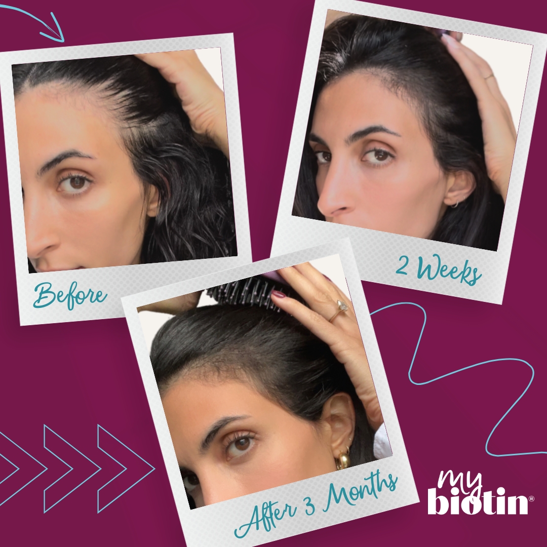 From struggle to stunning, see the MyBiotin Pro Clinical difference. Check out this fabulous hair transformation! 😍 Remember, perseverance pays off. 🎯 Based on consistent use. Individual results may vary.