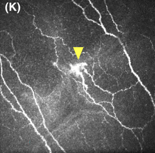 FrontTear_UoM's tweet photo. More research from our @FrontTear_UoM Research Centre @UnmelbDOVS led by amazing post-doc @Mengliang_Wu showing that hyperreflective nerve features on corneal confocal images not only occur in diseased eyes https://t.co/WCuwQeg2UM @ClinExpOphthal @holly_chinnery @UnimelbMDHS https://t.co/ZH5YUFwPdr