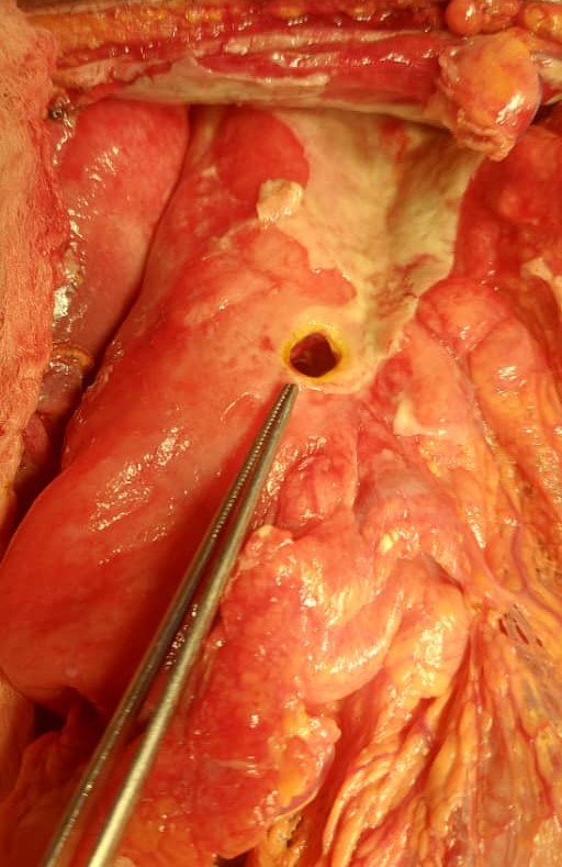 xsurgeon3's tweet photo. Perforated Gastric tumor (Greater curvature), subtotal gastrectomy D2, Billroth II was performed during weekend oncall , waiting for R results,  #surgeryteam @anniaramosperez @DrJaiteh @xsurgeon3 @LaminOBeyai @KGHTheGambia @KanifingDOM #generalsurgery https://t.co/mVYCtnV8Lg