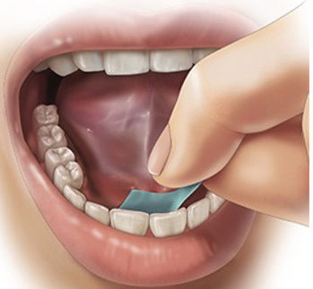 kfatweets's tweet photo. Under-the-tongue epinephrine film, Anaphylm™ from Aquestive Therapeutics, Inc. shows positive systemic #epinephrine delivery as effectively as commercially available autoinjectors. Read more: https://t.co/3FRqqILhTs https://t.co/R3oGuBRfaZ