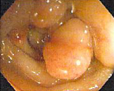 LizMontgomeryMD's tweet photo. f you are not onto it, endometriosis can be a huge fooler and present as a mass lesion.  Worse, the stroma can stain with  DOG1!  Ouch. #UMiamiPath https://t.co/HtAGxIcLP8