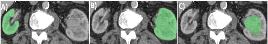 urotoday's tweet photo. Point of care parenchymal volume analyses to estimate split renal function and predict functional outcomes after radical nephrectomy. #BeyondTheAbstract with @RathiNityam and @SCampbellMDPhD @CleClinicUro on UroToday > https://t.co/SgGuMBAXgh @SciReports https://t.co/3WlcfYqt4A