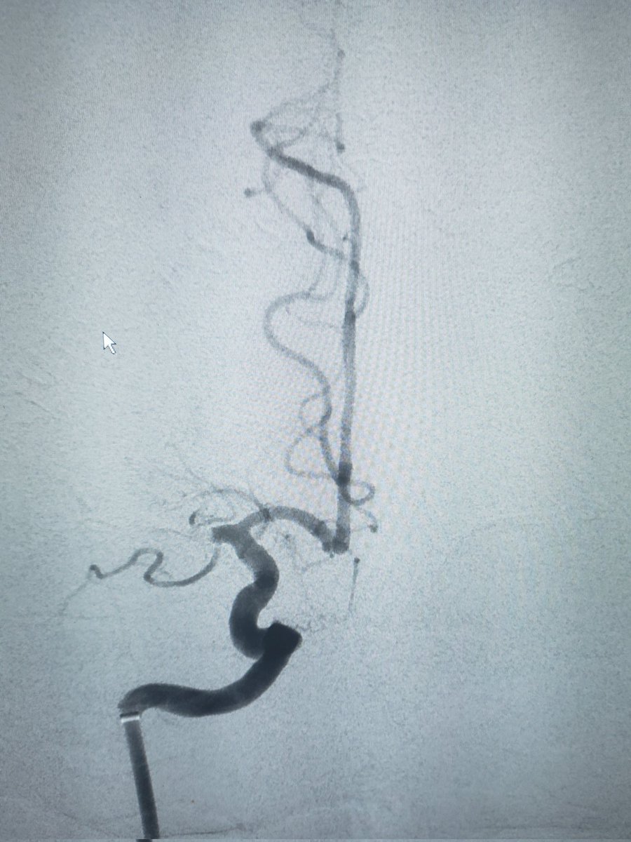 DennysReyesMD's tweet photo. Right Carotid Occlusion w NIHSS=22. Angioplasty w Sterling 5.0, Aspiration w RED 62, &amp; Carotid Stent w XACT through BMX096. TICI 3. 24hrs NIHSS=4. @PenNeuro #health #stroke #brain #emergency #fitness #fitnessmotivation #vessel #safe #life #actor #time #ems #palmbeach #medicine https://t.co/P8okmibf92
