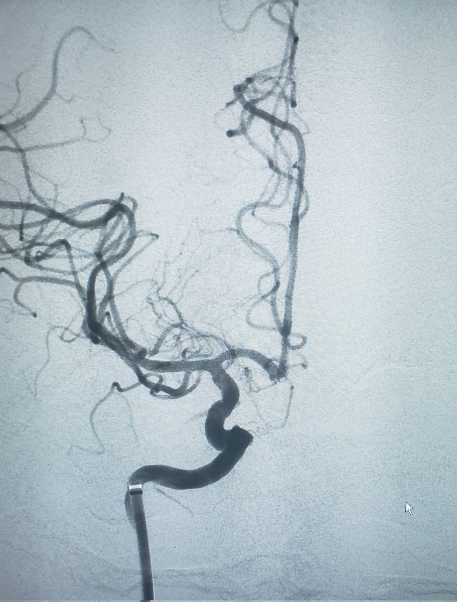DennysReyesMD's tweet photo. Right Carotid Occlusion w NIHSS=22. Angioplasty w Sterling 5.0, Aspiration w RED 62, &amp; Carotid Stent w XACT through BMX096. TICI 3. 24hrs NIHSS=4. @PenNeuro #health #stroke #brain #emergency #fitness #fitnessmotivation #vessel #safe #life #actor #time #ems #palmbeach #medicine https://t.co/P8okmibf92