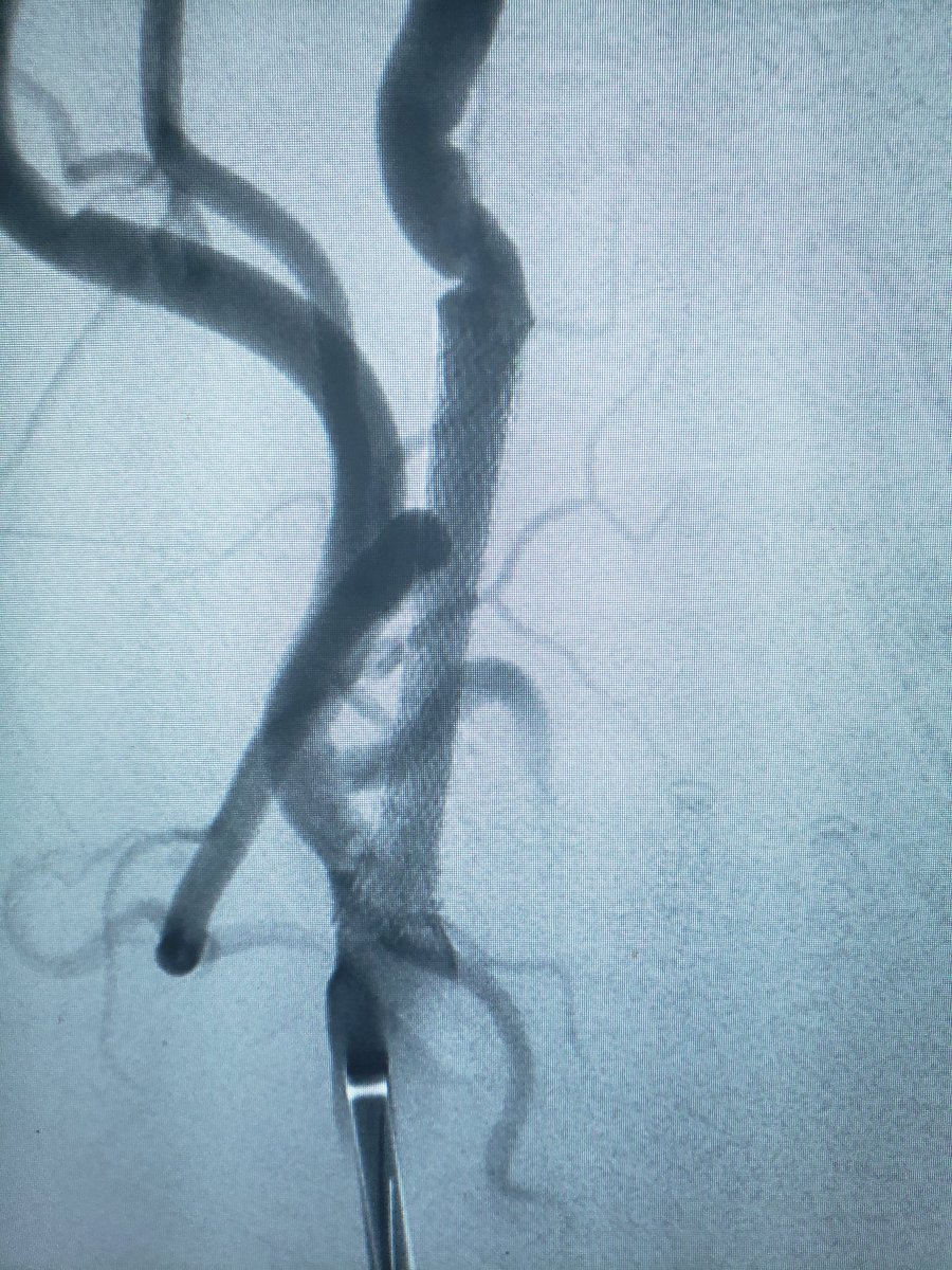 DennysReyesMD's tweet photo. Right Carotid Occlusion w NIHSS=22. Angioplasty w Sterling 5.0, Aspiration w RED 62, &amp; Carotid Stent w XACT through BMX096. TICI 3. 24hrs NIHSS=4. @PenNeuro #health #stroke #brain #emergency #fitness #fitnessmotivation #vessel #safe #life #actor #time #ems #palmbeach #medicine https://t.co/P8okmibf92