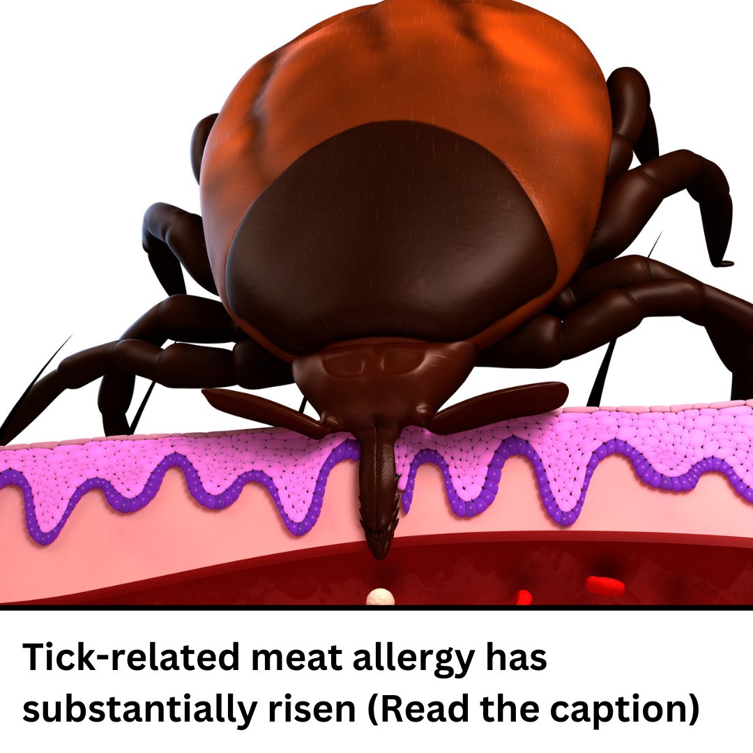 CS_Repellent's tweet image. All Canadians! As you explore the outdoors this summer, stay vigilant about tick-borne. Recent CDC studies in the US show a rise in suspected alpha-gal syndrome (AGS) cases, a tick bite-linked allergic condition causing red meat allergy.

Get yours: Canadianshieldrepellents.ca 🇨🇦🦟