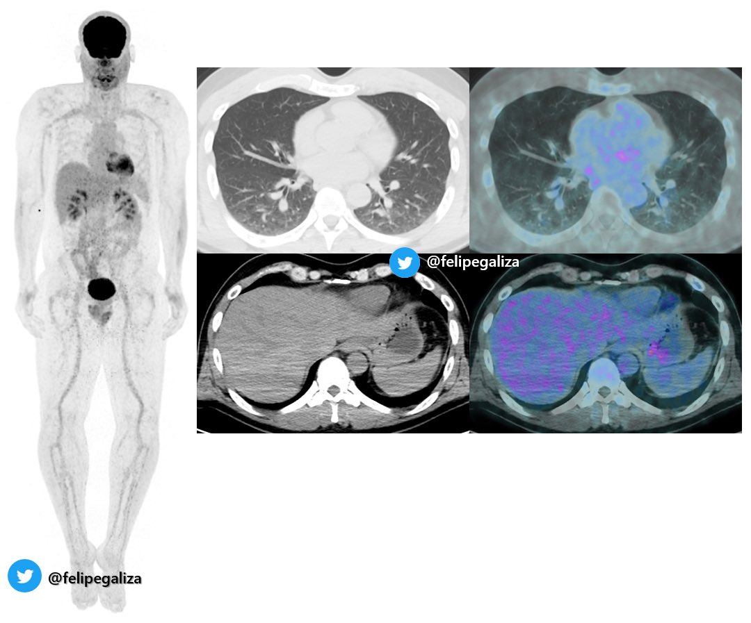 Felipegaliza's tweet photo. 😊The beauty of precision Oncology

48yo M
Metastic Melanoma w/ BRAF mutation 

💊1L Ipi + Nivo (progression dis)

🧬2L: Dabrafenib + Trametinib (BRAF + MEK)

☢️PET/CT: impressive complete response after 6mo of target therapy 

#radres #FOAMrad #oncology https://t.co/gmaWndNLbJ