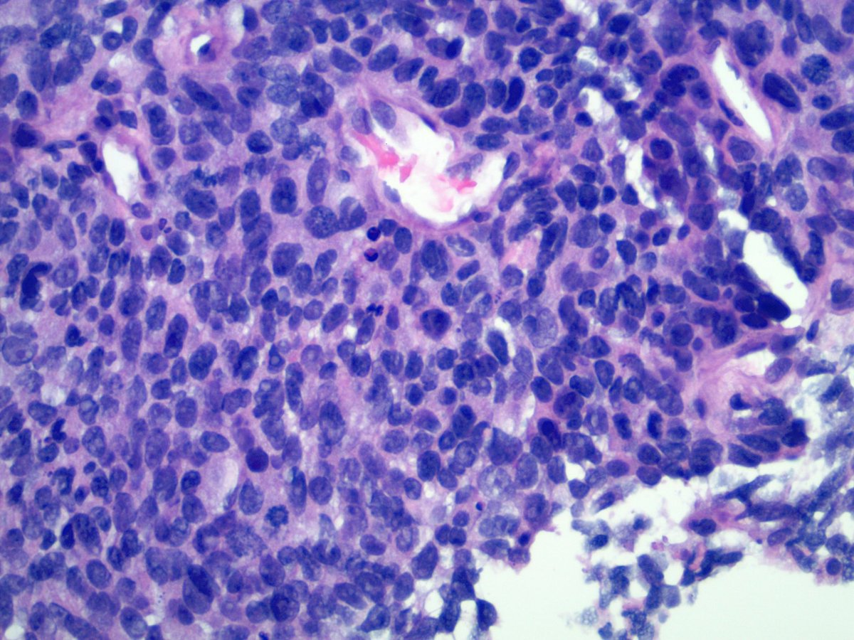 smlungpathguy's tweet photo. How many mitoses in this pic? https://t.co/Jq2WH9SPMM