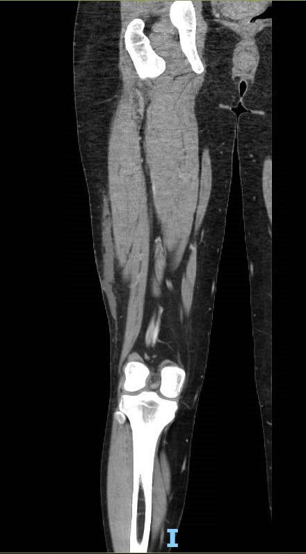 orthoEMpearls's tweet photo. Confusion over a contusion. Pt presents to ED w/ progressively worsening thigh pain after a MVC 2 wks ago. What’s the Dx? #FOAMed #emergencymedicine

https://t.co/aFOAcbp5qz https://t.co/0ho4HphjzD