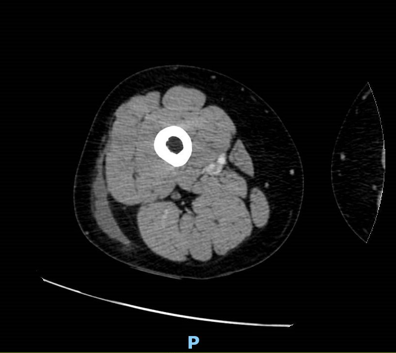 orthoEMpearls's tweet photo. Confusion over a contusion. Pt presents to ED w/ progressively worsening thigh pain after a MVC 2 wks ago. What’s the Dx? #FOAMed #emergencymedicine

https://t.co/aFOAcbp5qz https://t.co/0ho4HphjzD