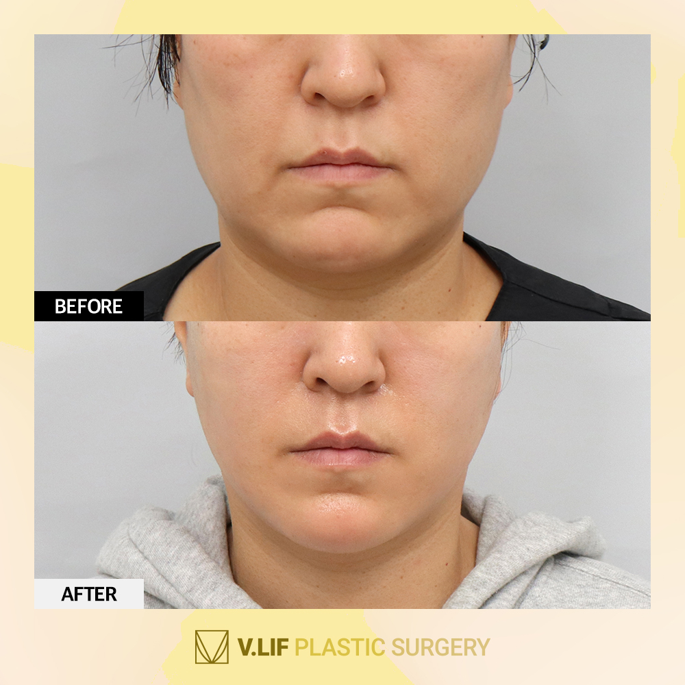 Facelift Surgery at V.LIF💛
#koreacosmetic #aestheticsurgery #plasticsurgeryclinic #smaslifting #jowls #faceliftsurgery #liposuctionbeforeandafter #saggingskin #antiwrinkles #definedjawline #vlifplasticsurgery