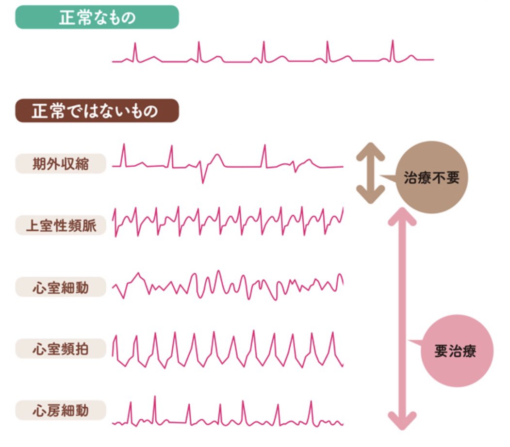 心電図 異常 波形 一覧