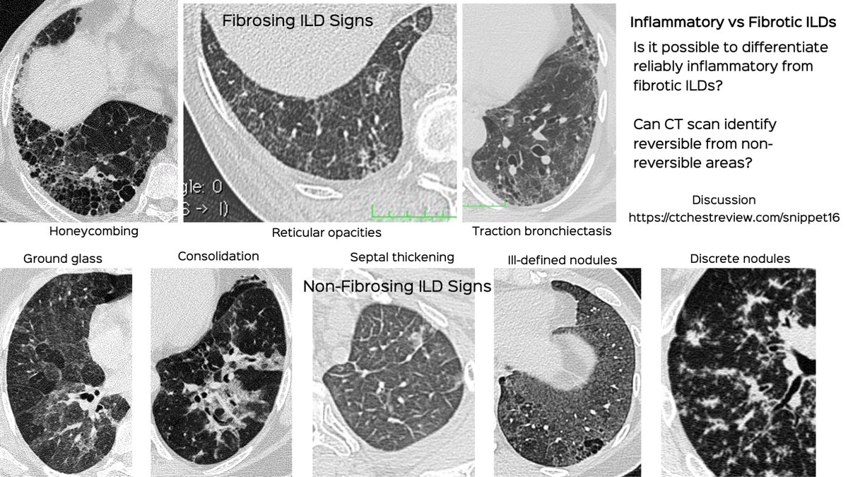 Is it Possible to Reliably Differentiate Inflammatory from Fibrotic ILD or Reversible from Irreversible Disease?

Discussion video

ctchestreview.com/snippet16

#chestrad #ctchest #FOAMrad #radres #ILDs #interstitiallungdisease
