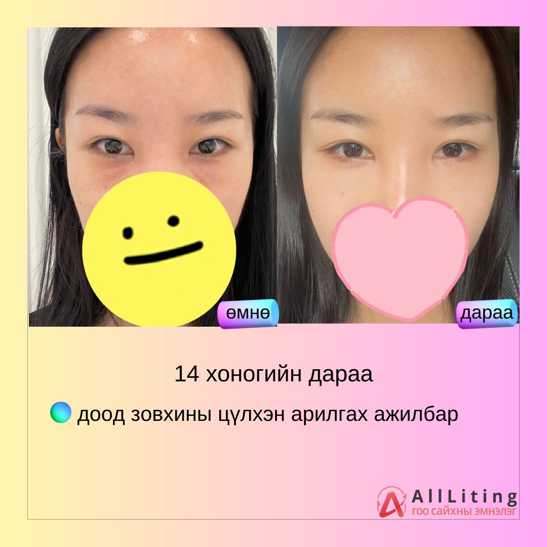 #ҮЙЛЧЛҮҮЛЭГЧИЙН_БОДИТ_ҮР_ДҮН
#ALL_Liting #ЦҮЛХЭН_УУТАНЦАР

хийлгэсэн ажилбар
📷доод зовхины цүлхэн арилгах ажилбар
-------------------------
📷📷 ҮЗЛЭГ/ЗӨВЛӨГӨӨ үнэгүй хийж зөвхөн таньд тохирсон мэс заслын төлөвлөгөөг гаргана.
📷монгол ажилтан: 010-4931-4451