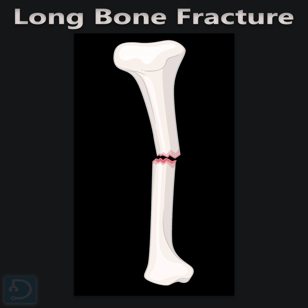 Docsteth1's tweet photo. Fractures of long bones are painful and challenging. The key to recovery is rest, proper care, and rehabilitation.
Learn📚 more about this topic at🔗https://t.co/5d200ttXbD
#LongBoneFracture #BoneInjury #MedEd #Docsteth #FractureRecovery #BoneHealth #InjuryCare #HealthTips #Med https://t.co/0PN4BwJvx8